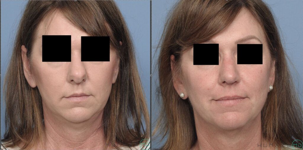 Rhinoplasty