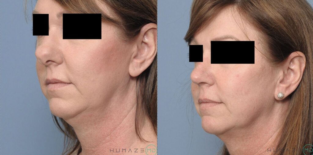 Rhinoplasty
