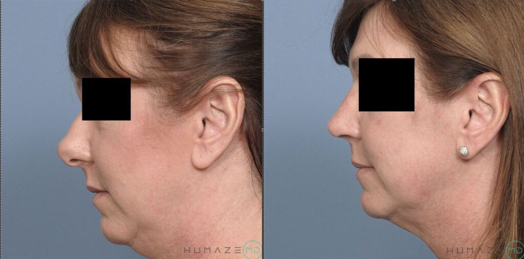 Rhinoplasty