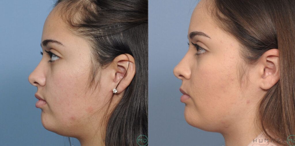 Chin implant