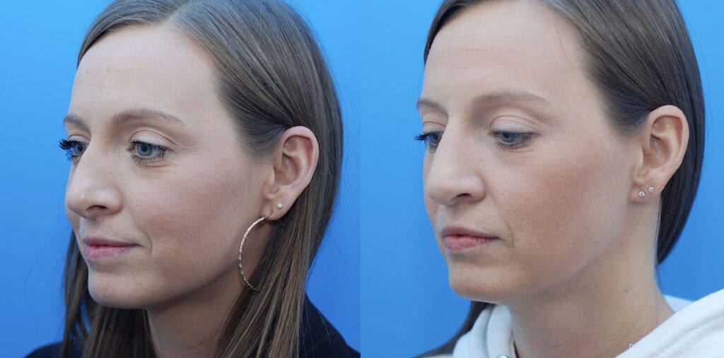 Revision Rhinoplasty