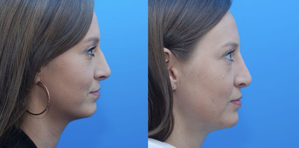 Revision Rhinoplasty