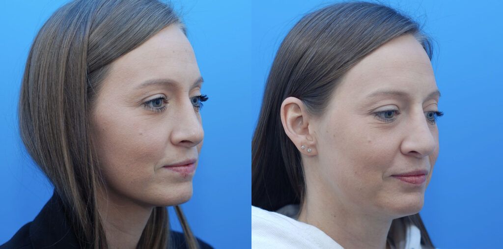 Revision Rhinoplasty