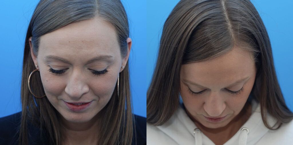 Revision Rhinoplasty