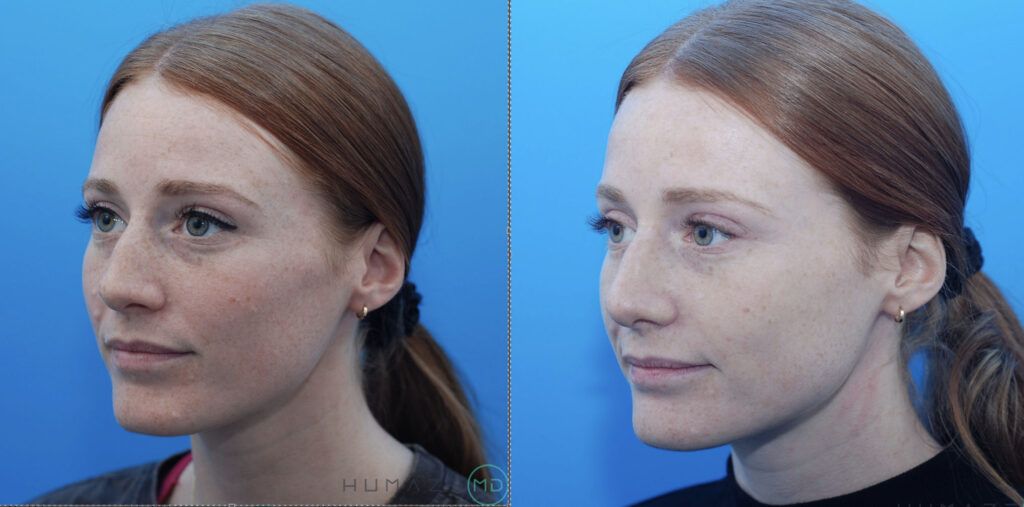 Rhinoplasty
