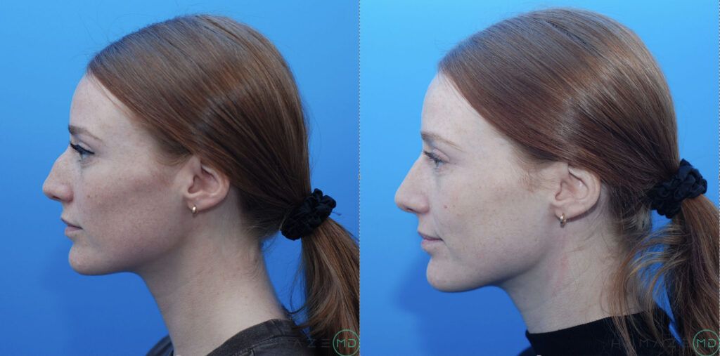 Rhinoplasty