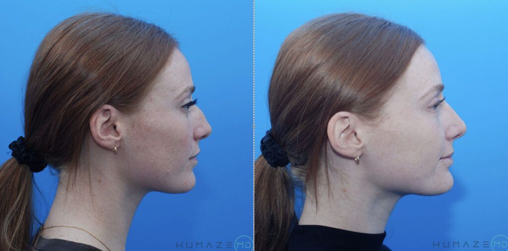 Rhinoplasty