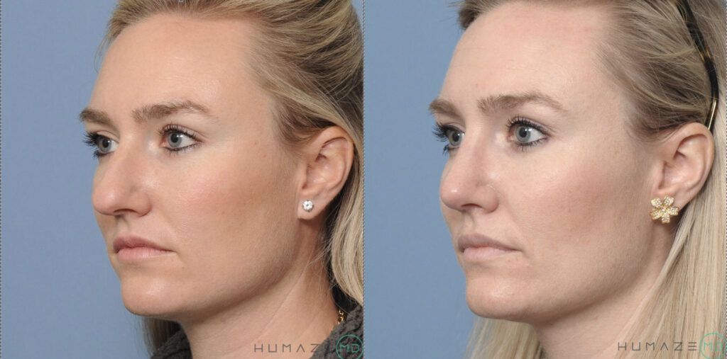 Rhinoplasty