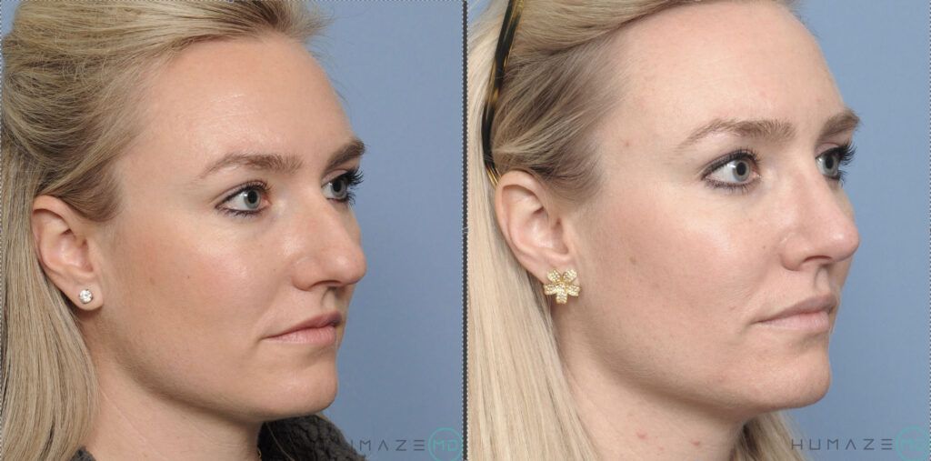 Rhinoplasty