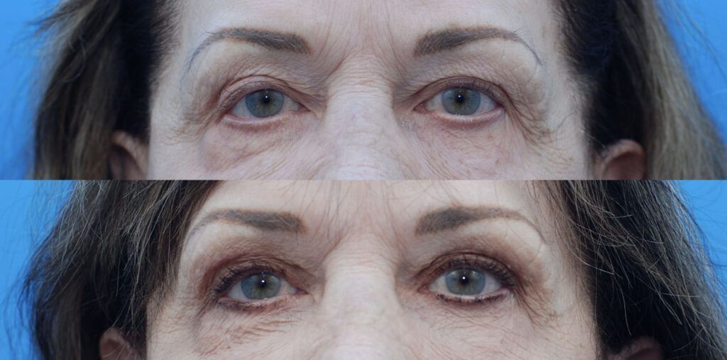 Lip lift, Upper bleph