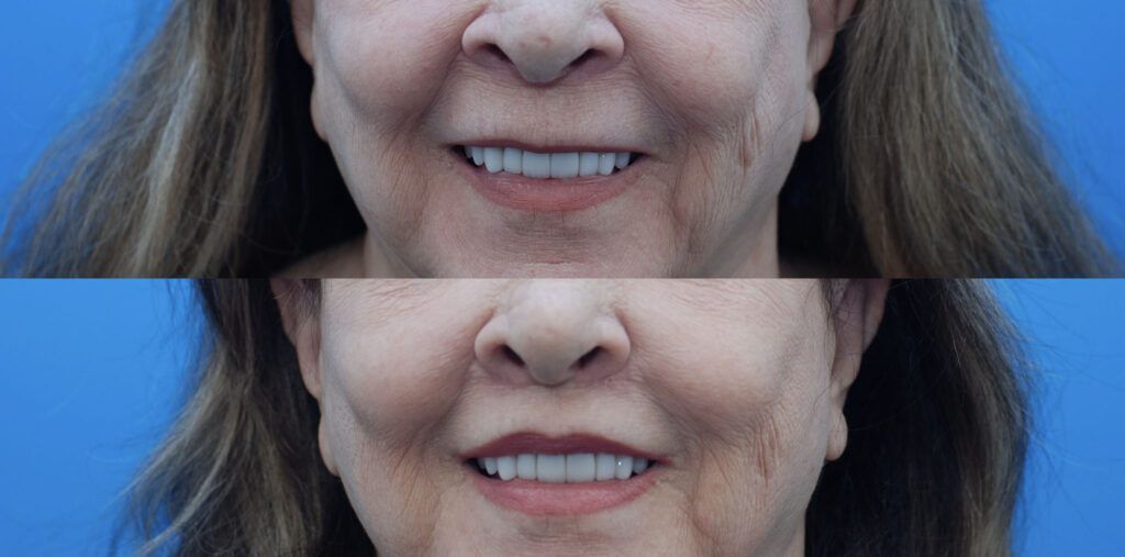 Lip lift, Upper bleph