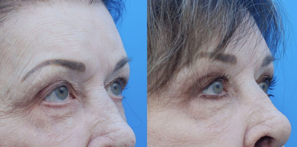 Lip lift, Upper bleph