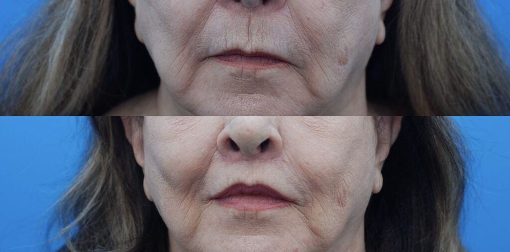 Lip lift, Upper bleph