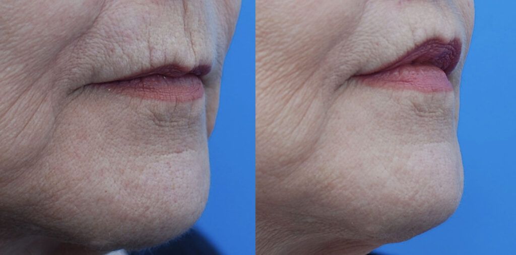 Lip lift, Upper bleph