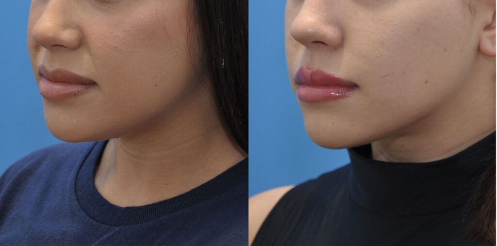 Necklift and liposuction