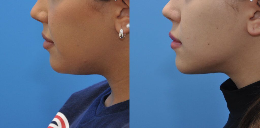 Necklift and liposuction