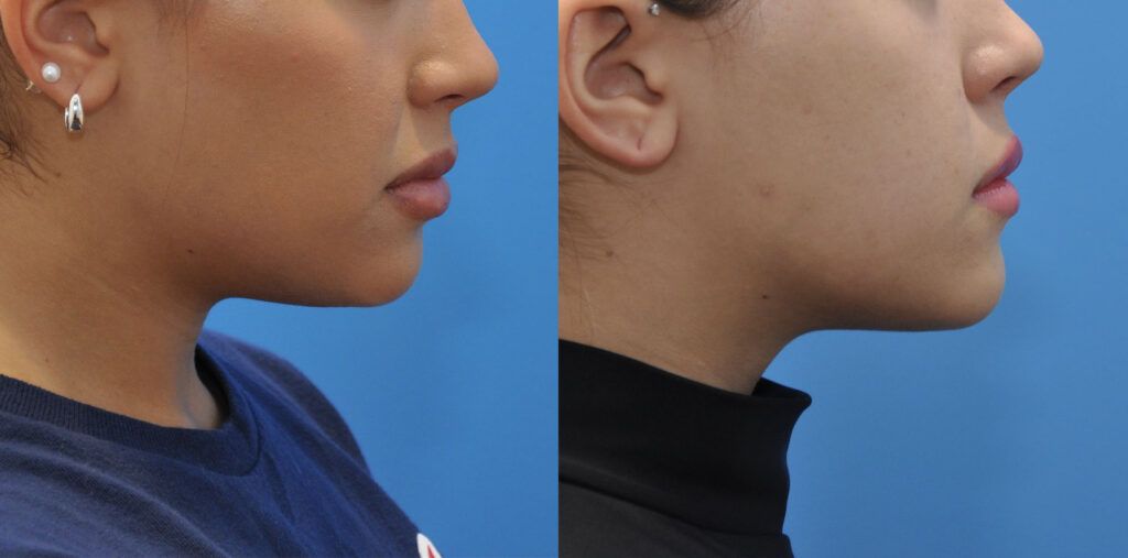 Necklift and liposuction