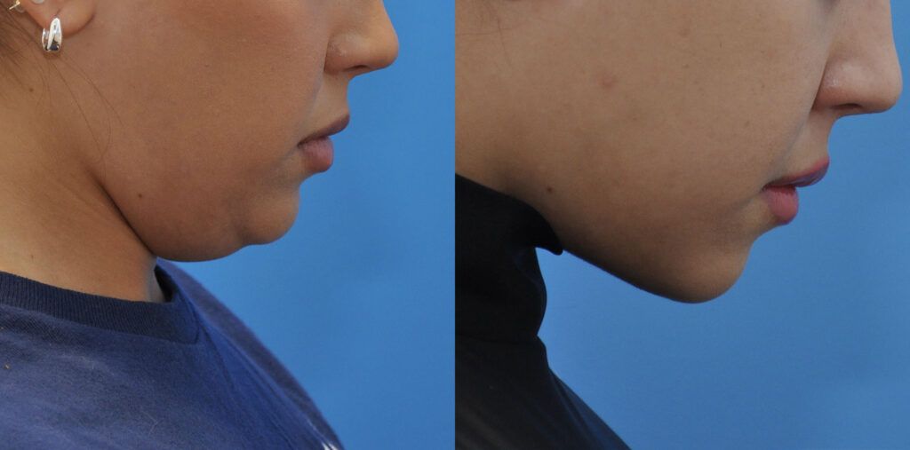 Necklift and liposuction