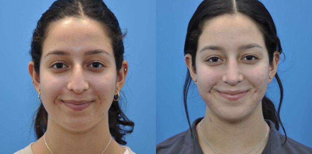 Rhinoplasty