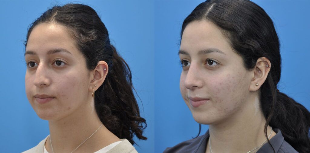 Rhinoplasty