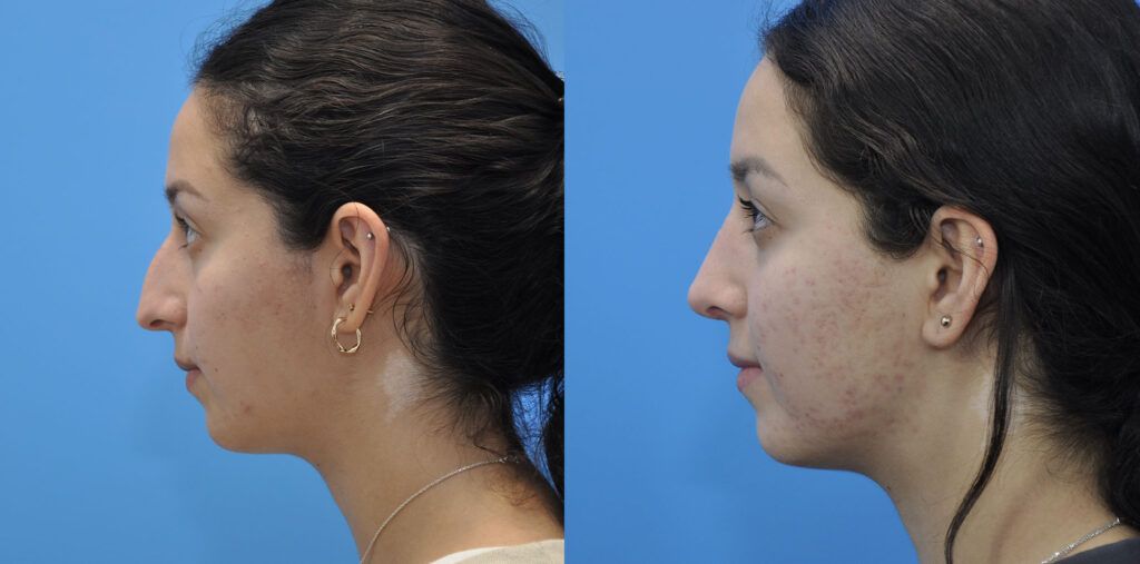 Rhinoplasty