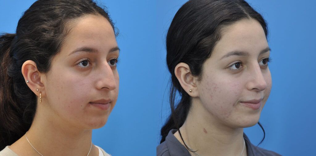 Rhinoplasty