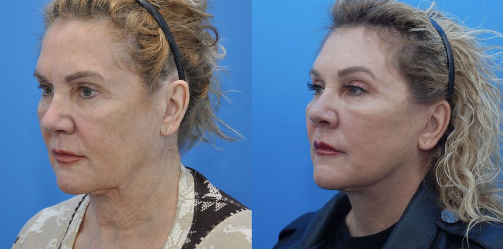 Browlift, lower bleph, fat grafting, facelift