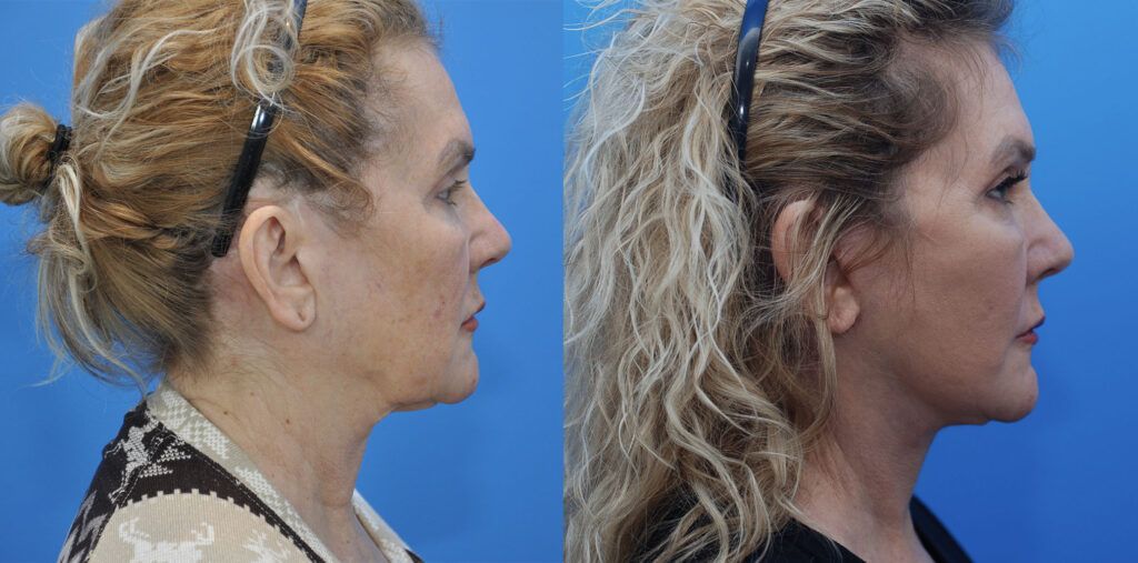 Browlift, lower bleph, fat grafting, facelift