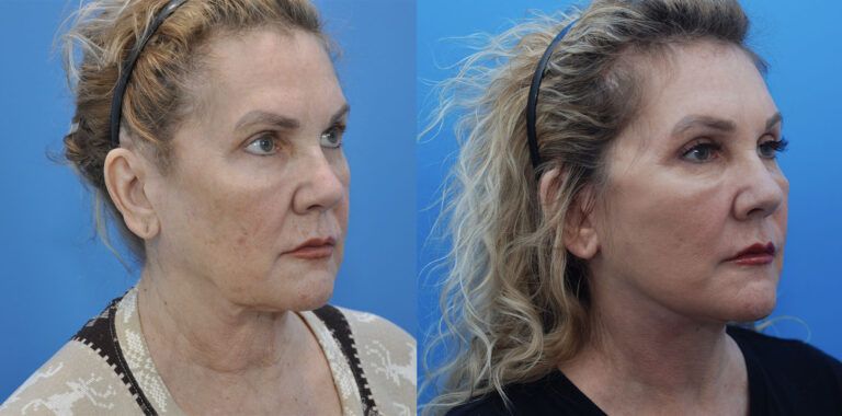 Browlift, lower bleph, fat grafting, facelift