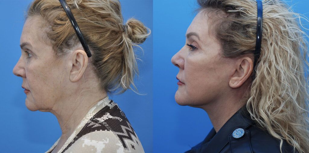 Browlift, lower bleph, fat grafting, facelift