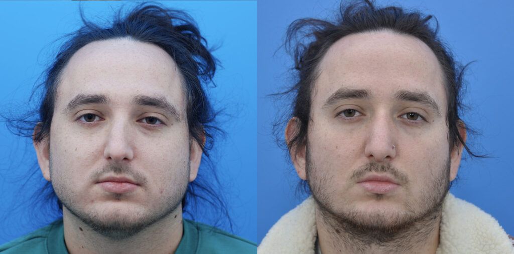 Rhinoplasty and Septoplasty