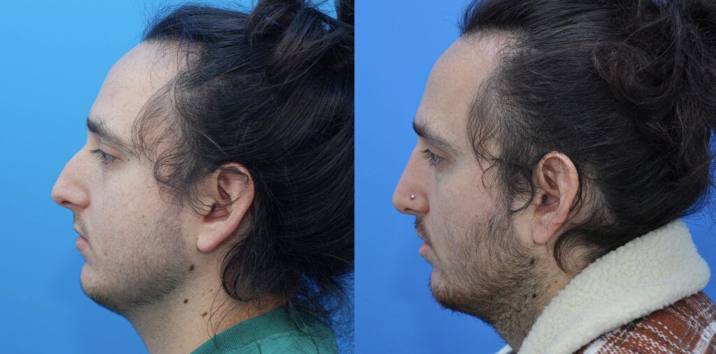 Rhinoplasty and Septoplasty