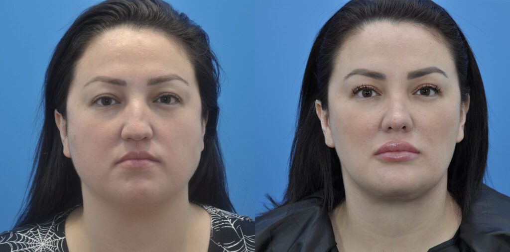 Necklift, upper bleph, rhinoplasty, buccal fat reduction, liposuction, chin implant