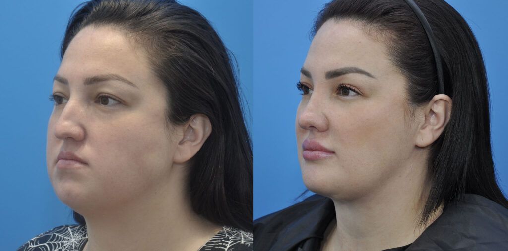 Necklift, upper bleph, rhinoplasty, buccal fat reduction, liposuction, chin implant