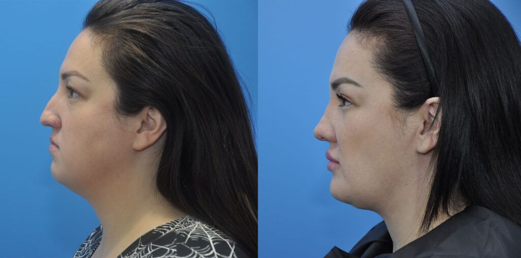 Necklift, upper bleph, rhinoplasty, buccal fat reduction, liposuction, chin implant