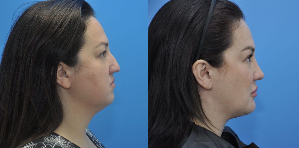 Necklift, upper bleph, rhinoplasty, buccal fat reduction, liposuction, chin implant