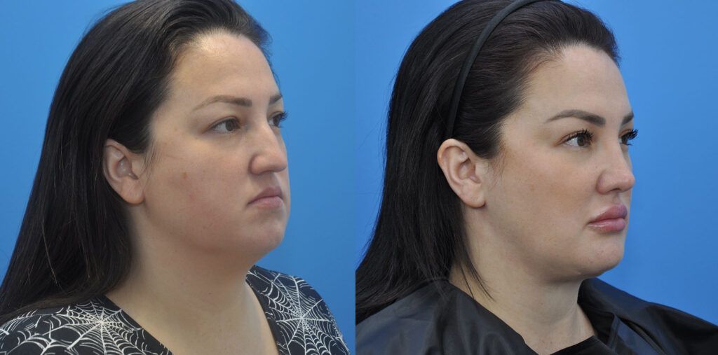 Necklift, upper bleph, rhinoplasty, buccal fat reduction, liposuction, chin implant