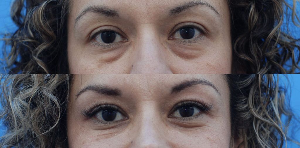 Lower blepharoplasty and rhinoplasty