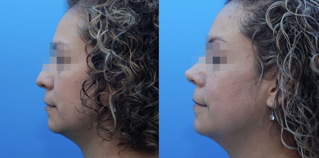 Lower blepharoplasty and rhinoplasty