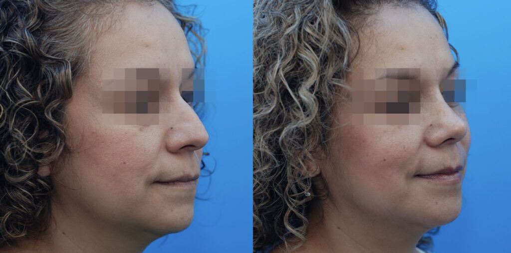 Lower blepharoplasty and rhinoplasty