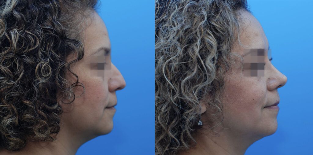 Lower blepharoplasty and rhinoplasty