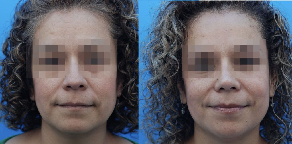 Lower blepharoplasty and rhinoplasty