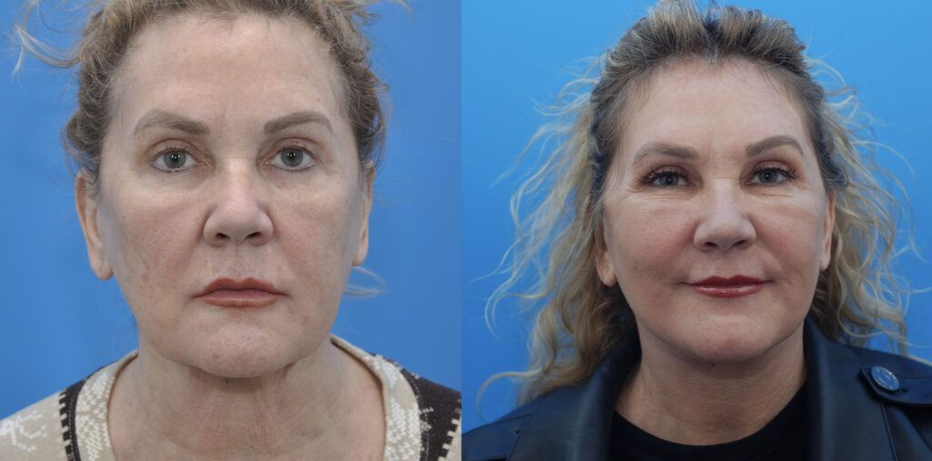 Browlift, lower bleph, fat grafting, facelift