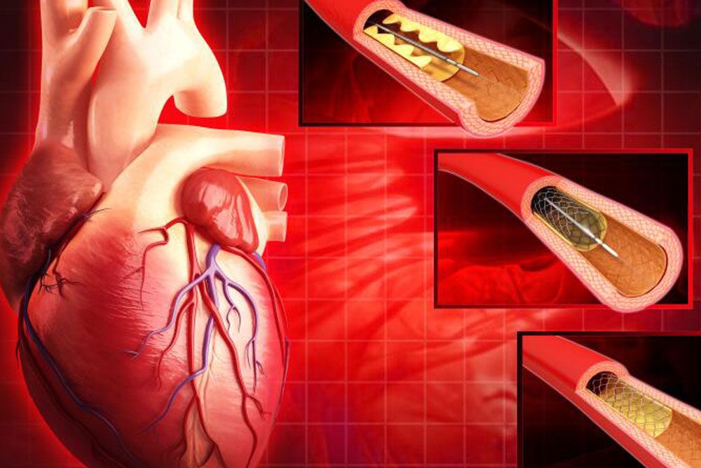 Cardiac cath illustration