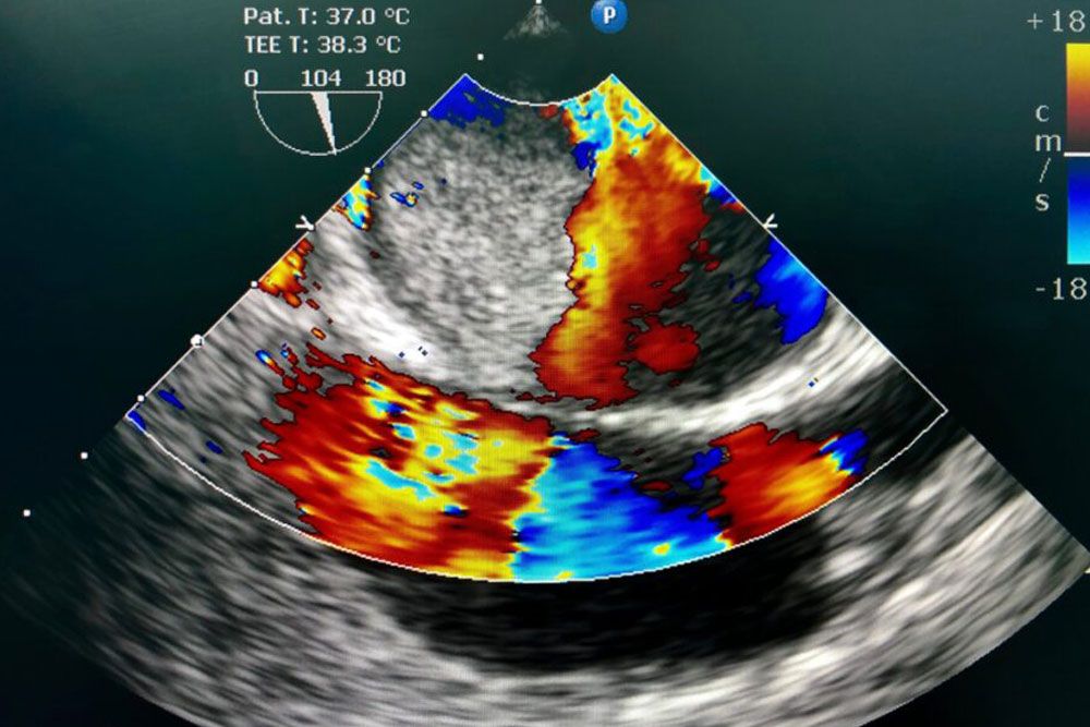 Image of the heart during transesophageal ultrasound