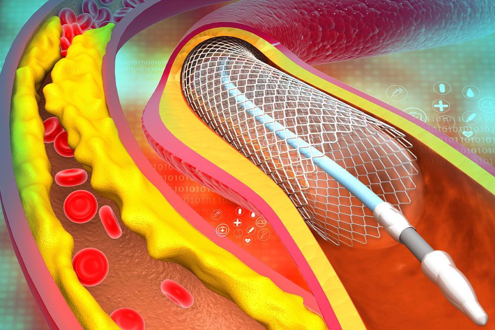 Coronary artery stent. 3d illustration