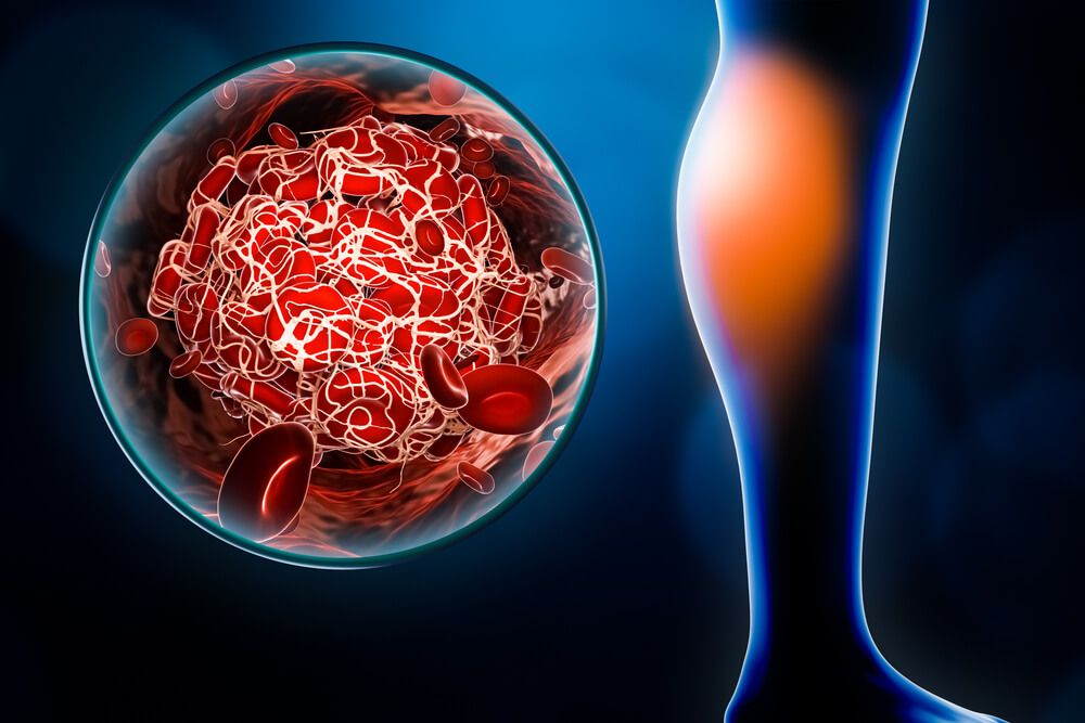 embolus located in the calf with blood clot