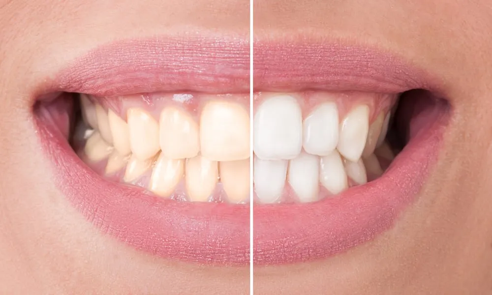 whitening