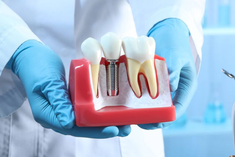 Dental implant and root canal dental display model