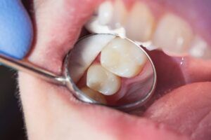 Close up of Composite Fillings